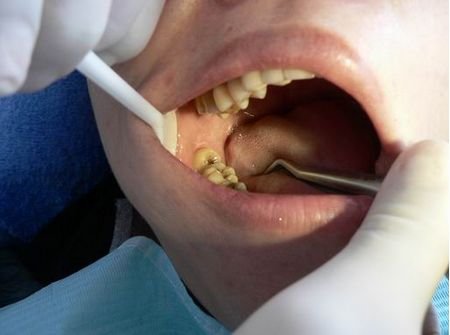 大牙不能治疗了,拔大牙有什么危害和注意事项?