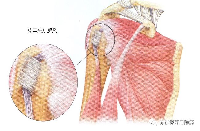 超聲引導治療肱二頭肌肌腱炎 (原創)