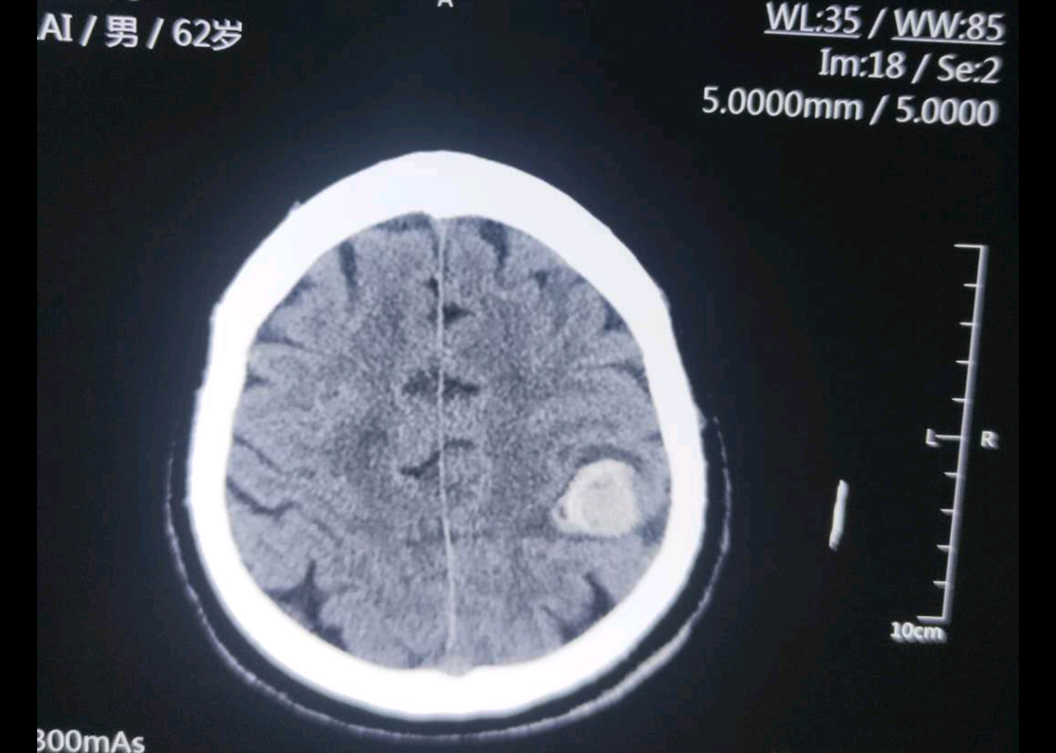 脑瘤诊断证明图片图片