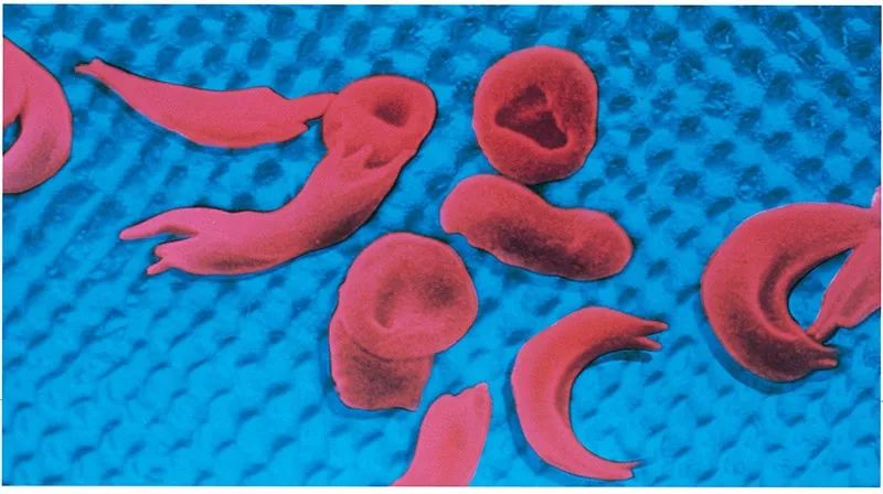 镰状细胞贫血是一种严重的疾病,是由于红细胞畸形遗传引起的