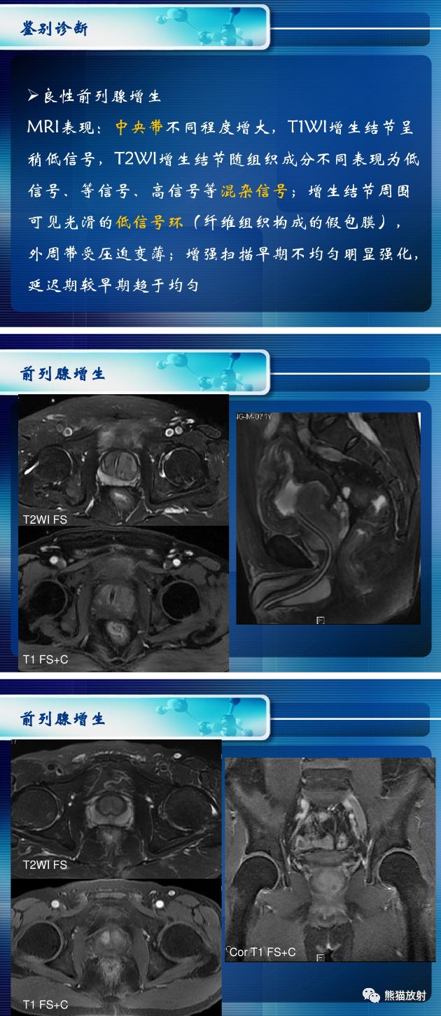前列腺磁共振正常图像图片