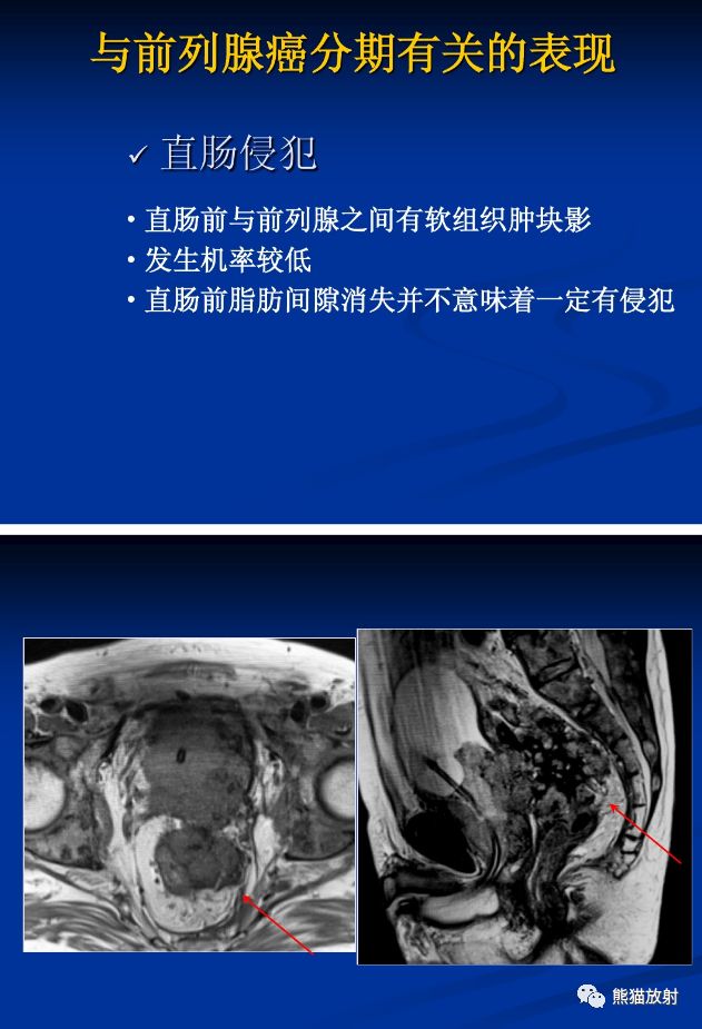 磁共振前列腺图像解析图片