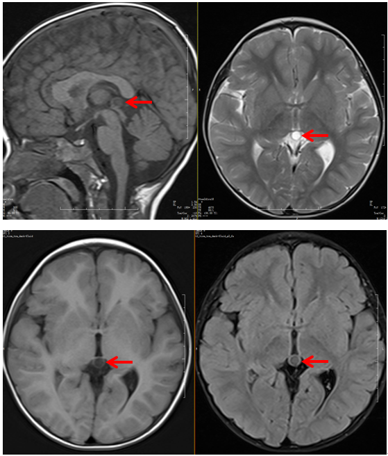 松果体囊肿图片