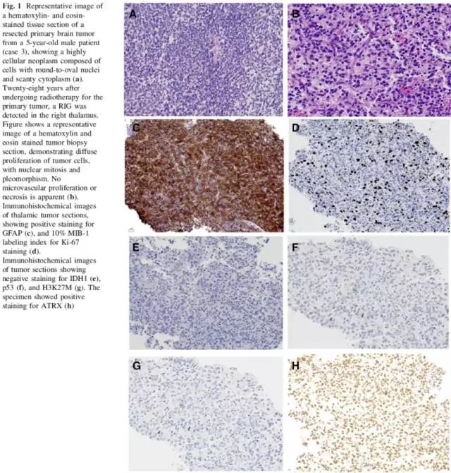 [研究]放疗诱发的胶质瘤:四例病例报道和分子标记物分析 西北胶质瘤