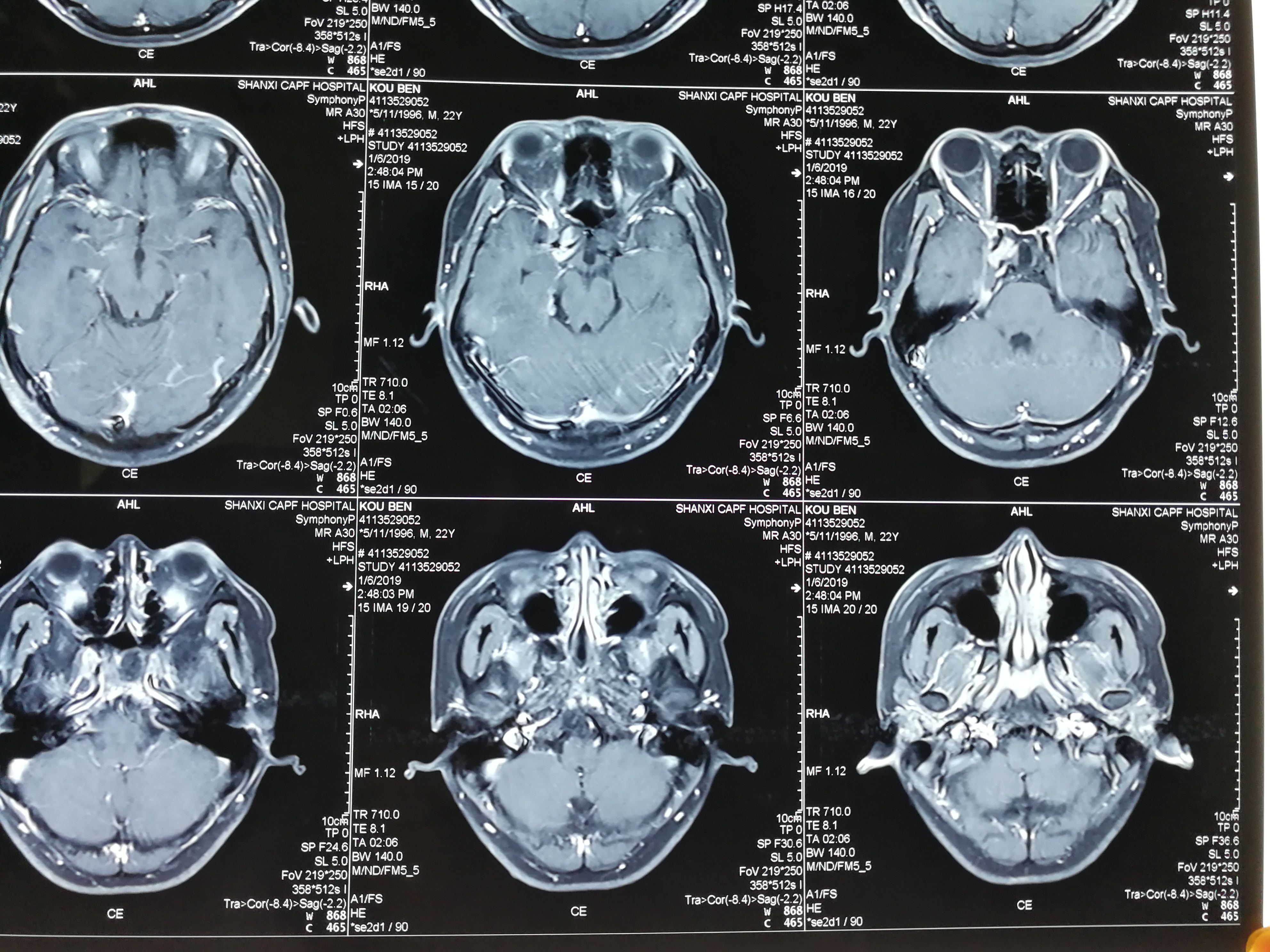 脑垂体磁共振图片