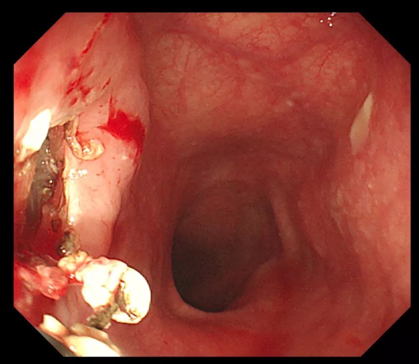 气管食管瘘图片 分型图片