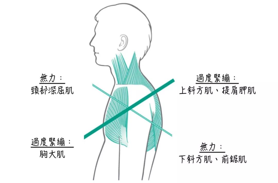 简单来讲,过于紧张的肌肉需要放松过度被拉伸的肌肉需要加强需要放松