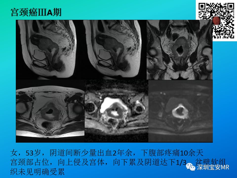 徵文作品mri在宮頸癌分期及術後評估中的應用