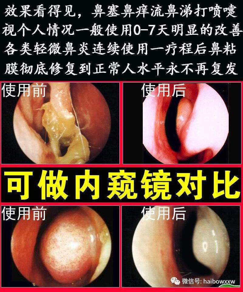 病人出現咽喉發癢,咳嗽,輕度聲嘶,嚴重者可出現會厭,聲帶粘膜水腫而