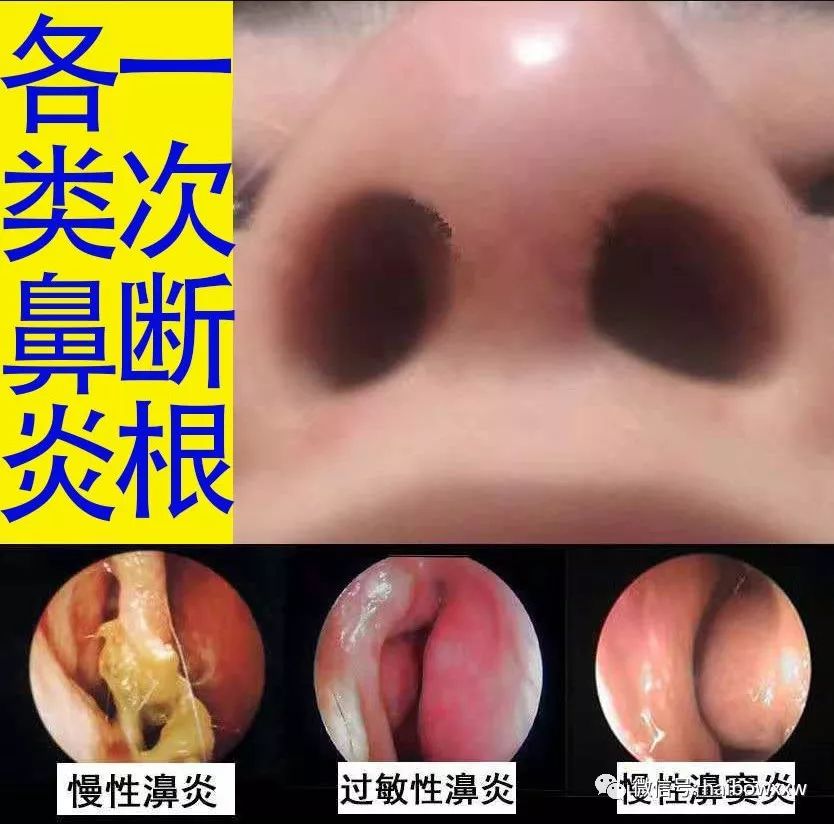 各种鼻炎的症状图片图片