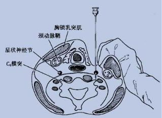 麻醉藥注射在含有星狀神經節的疏鬆結締組織內,從而阻滯支配頭面頸部