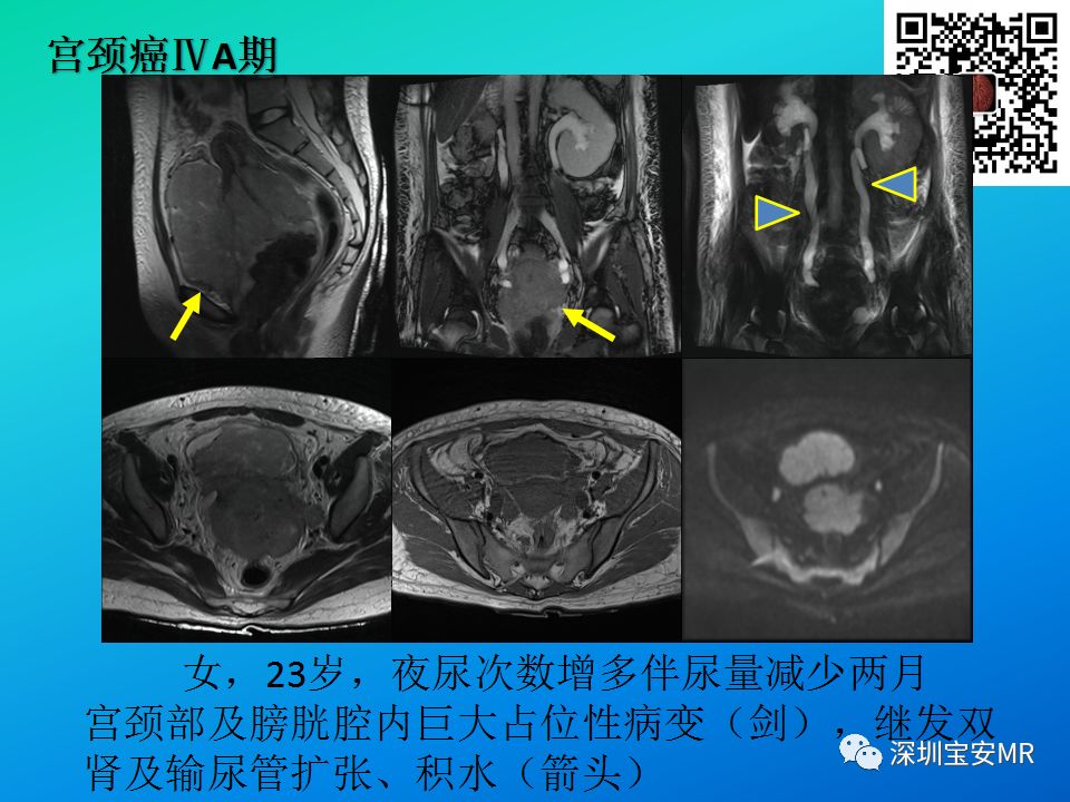 徵文作品mri在宮頸癌分期及術後評估中的應用