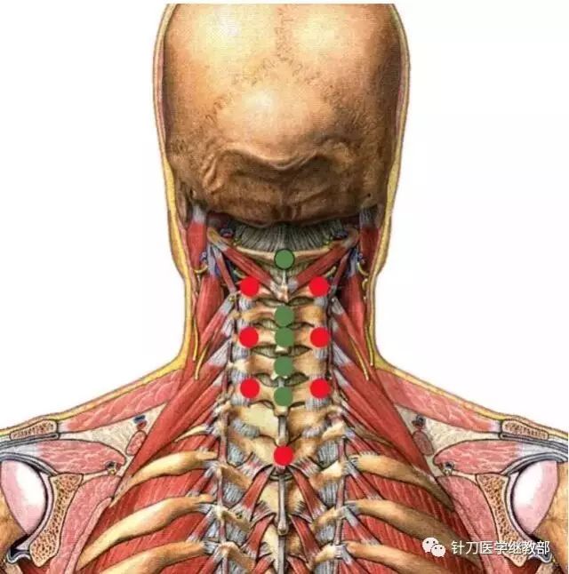 頸椎部分的針刀治療套路針刀人必備
