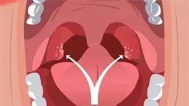 咽结合膜热图片