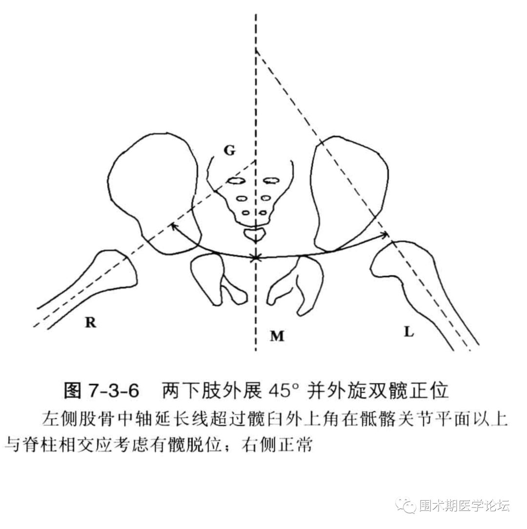 发育性髋关节脱位x线检查