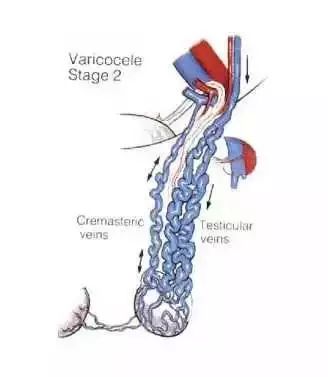 【男人帮】精索静脉曲张——男性不育的隐形杀手