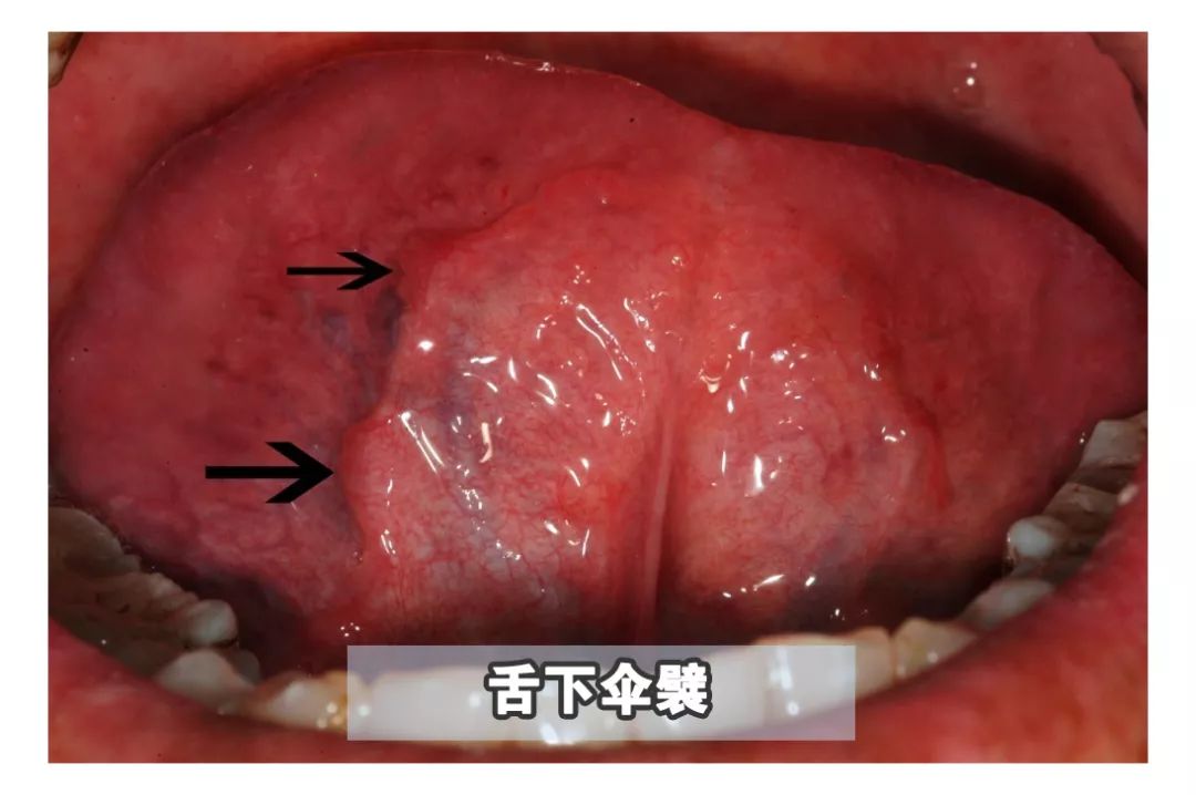 嘴裡長了可怕的肉揪真的不是口腔癌嗎