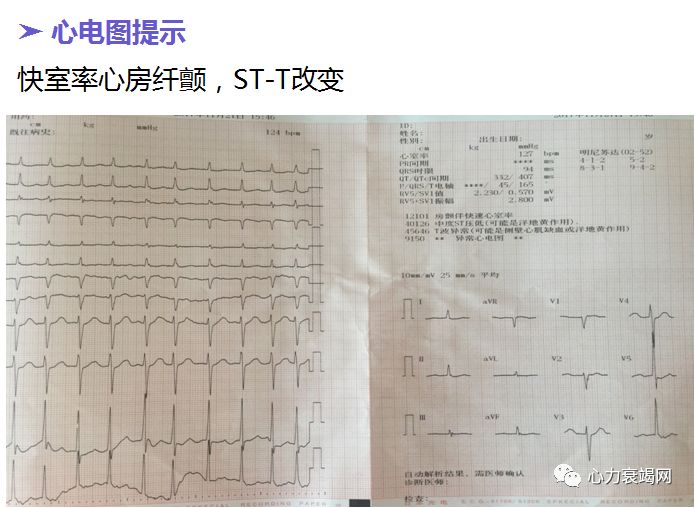 超濾病例大賽王軍教授超濾脫水療法容量超負荷心衰的剋星