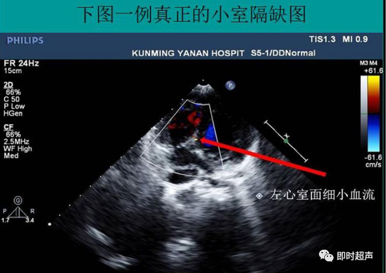 室间隔缺损超声图解图片