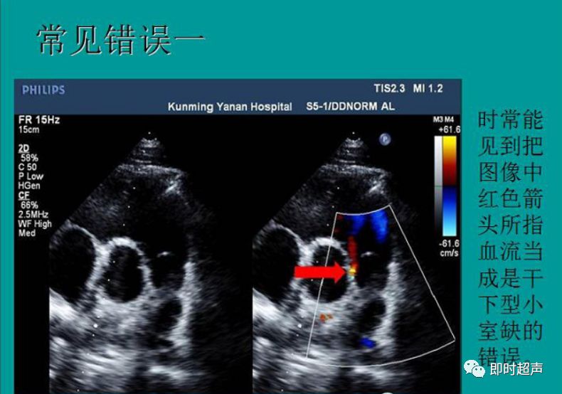 室间隔缺损超声图解图片