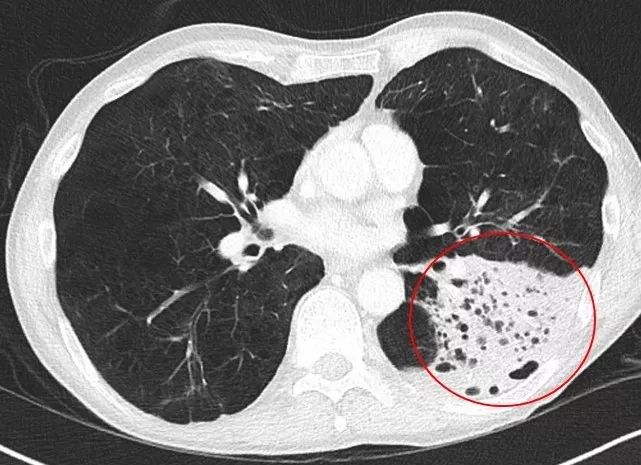 肺气肿的症状图片图片