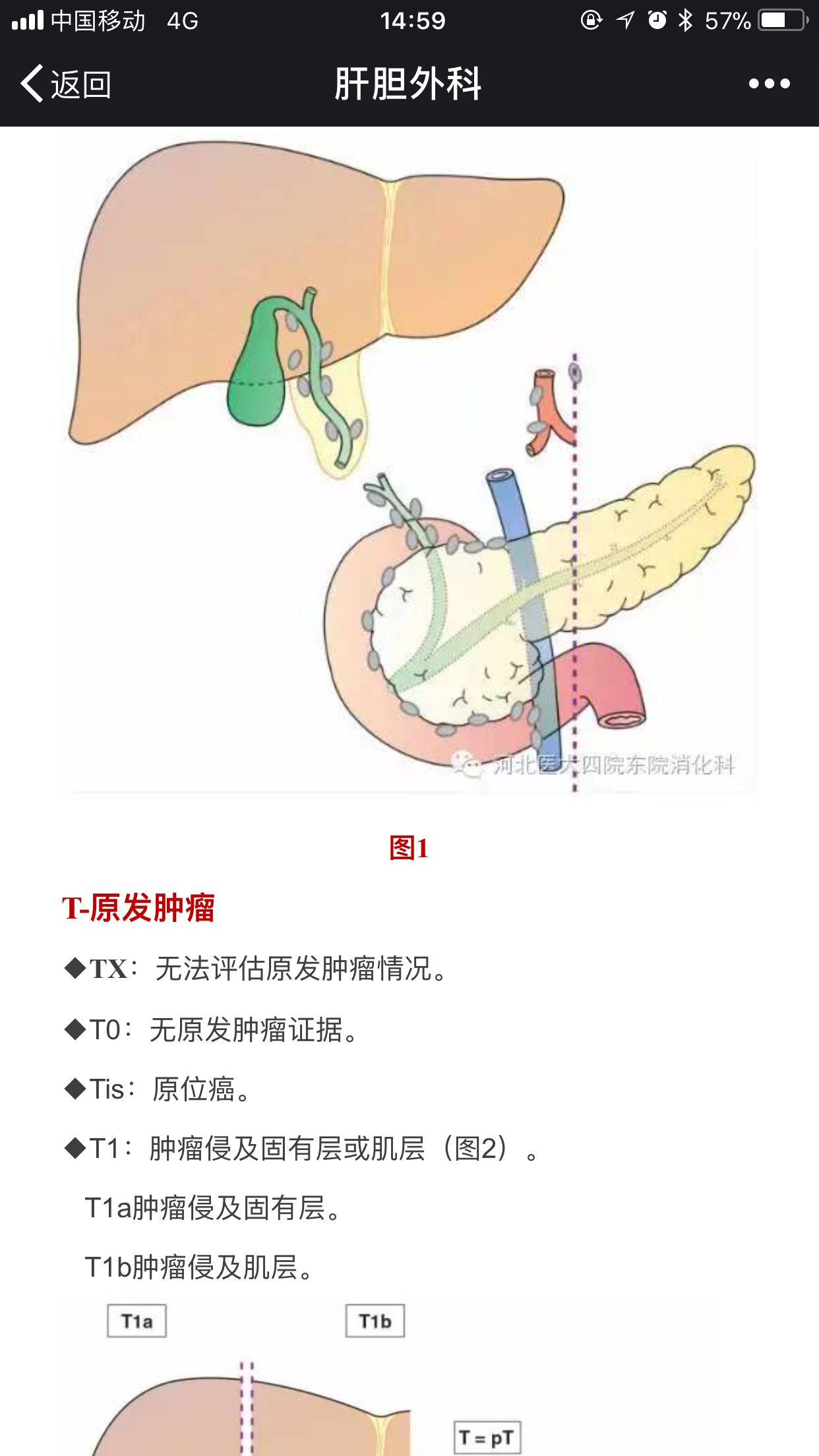 胆囊癌分期