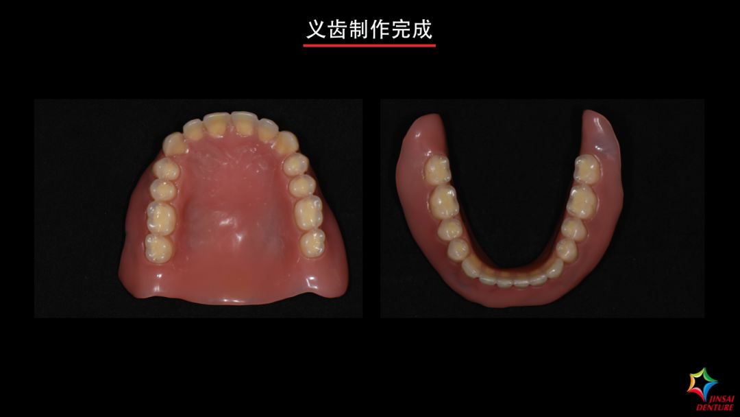 病例展示咀嚼系统协调因素和功能组织结构bps生物功能性吸附义齿修复