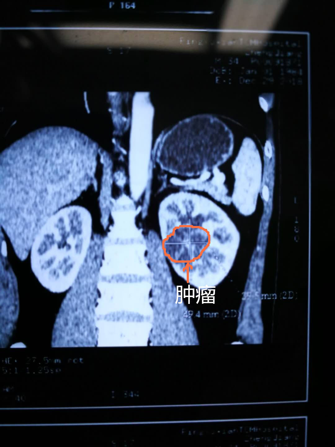 於2月前感覺左側腰部脹痛不適,在當地醫院做腎臟ct檢查發現左腎腫瘤