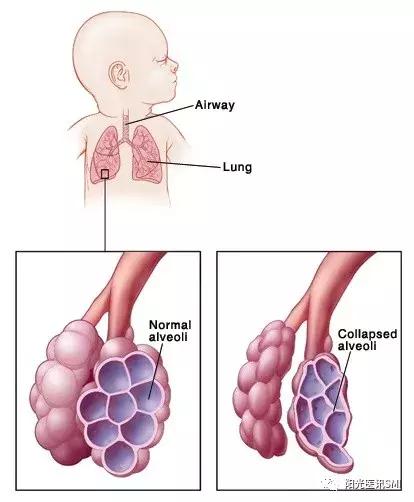 肺泡表面活性物质图片