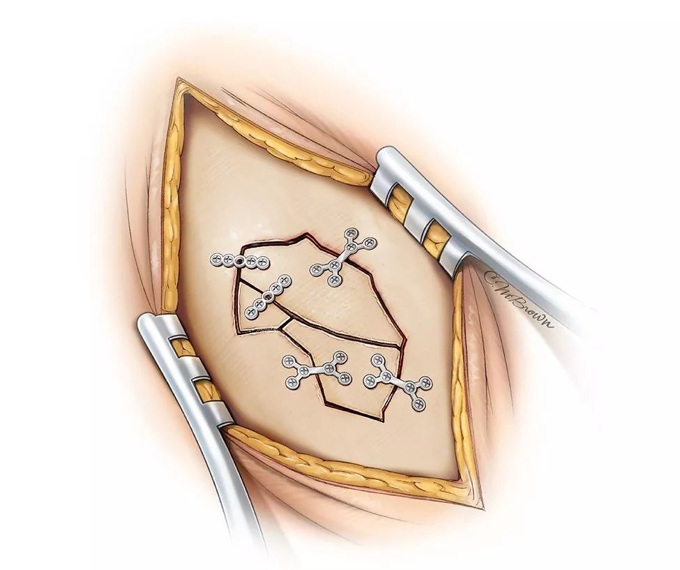 开放性颅骨骨折的手术策略与技巧 the neurosurgical atlas全文翻译