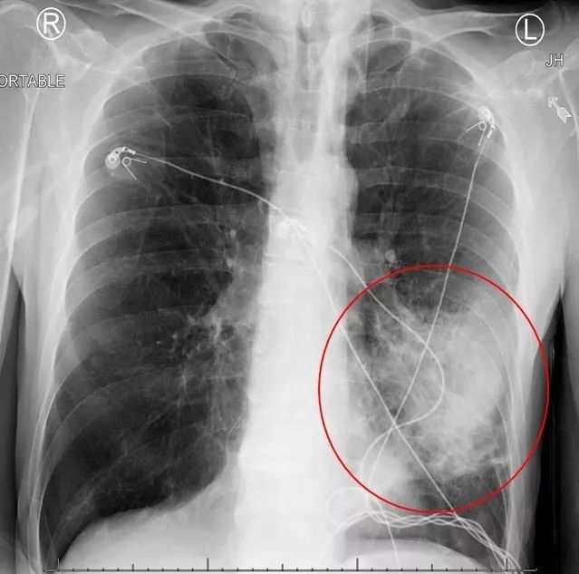 肺大泡x线表现图片图片