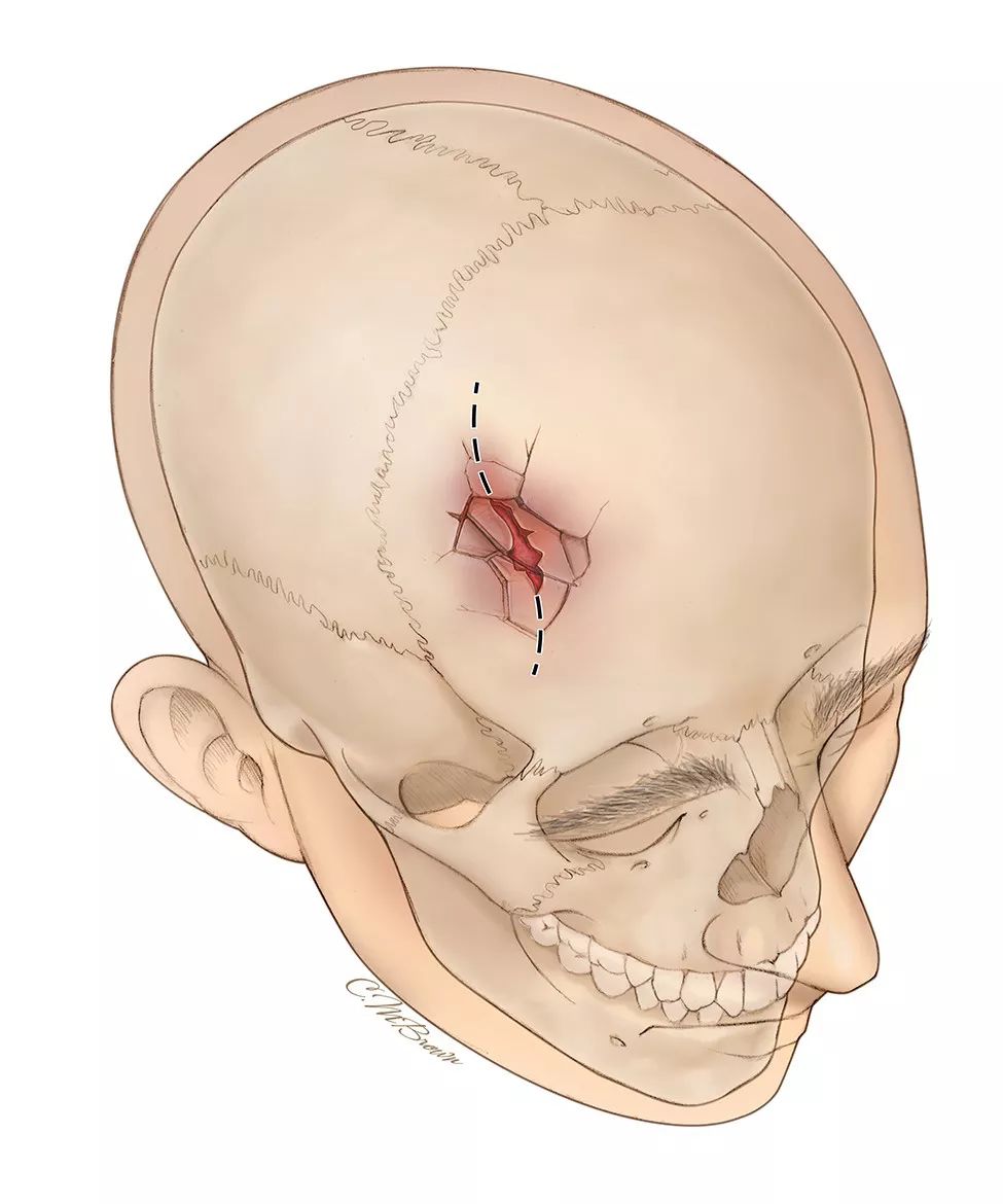 开放性颅骨骨折的手术策略与技巧 