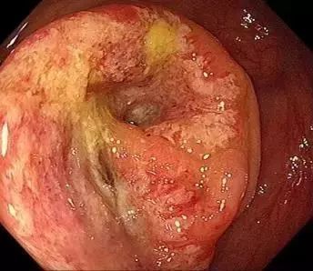 大肠癌肚子图片