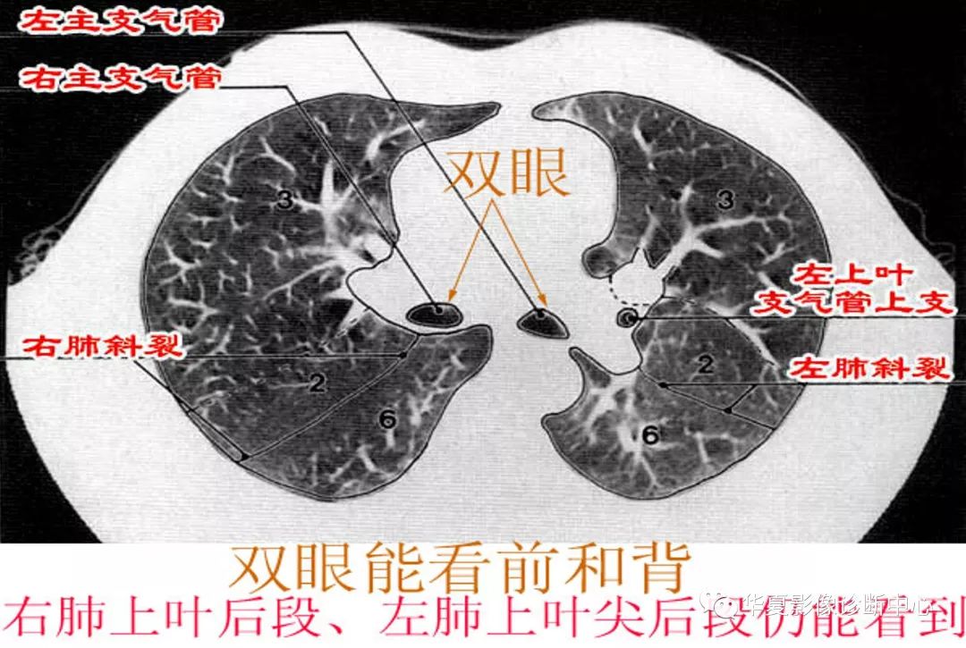 内有右上肺静脉的断面,此层面能看到右肺中叶,左上肺舌叶及两肺下叶背