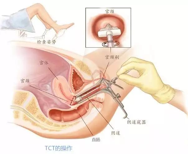 妇科全面检查 直肠图片
