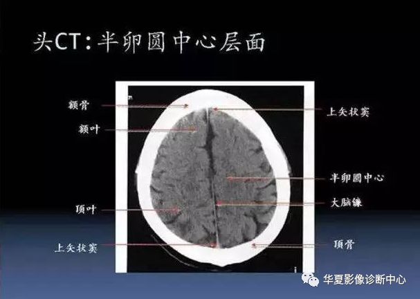 半卵圆中心解剖位置图图片