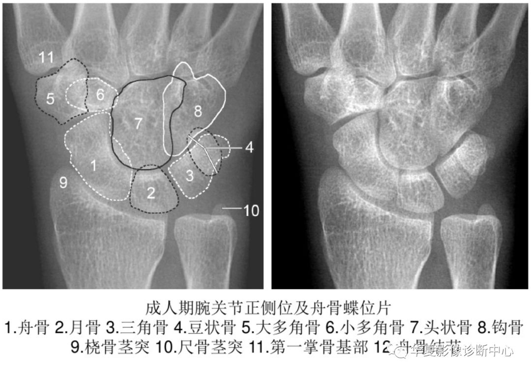 豆状骨图片图片