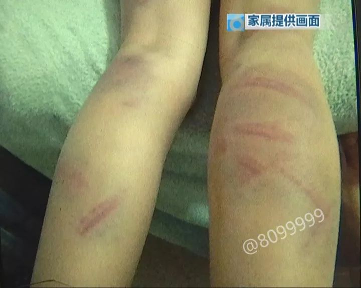 玉溪10歲女童腿部遍佈淤青疑遭班主任施暴校方確有此事