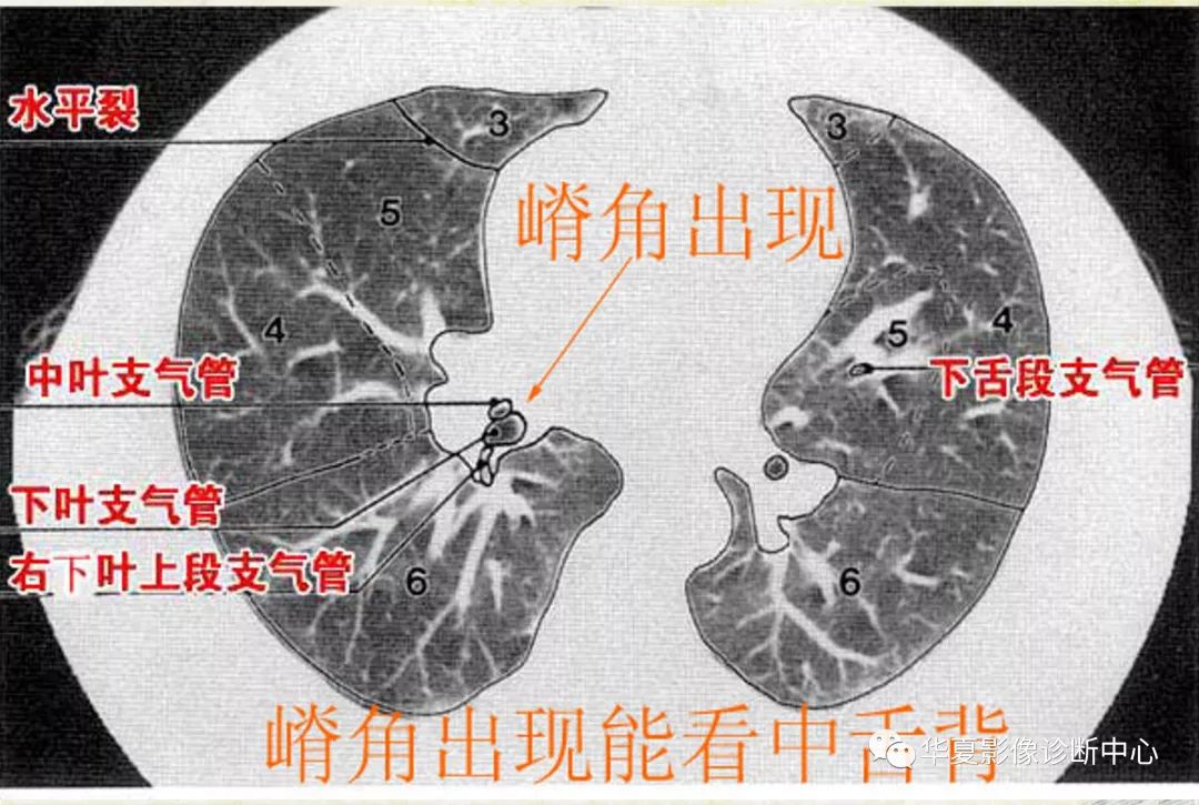 注④:基底干现观中舌余下肺两下叶支气管分出基底段时能观察中叶