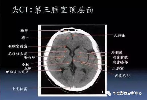 聽眥線層面 亦稱顱底平面( 00mm )九面:聽眥蝶鞍三下上 體頂卵園灰質