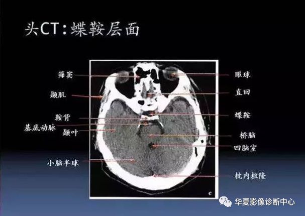 00mm )九面:聽眥蝶鞍三下上 體頂卵園灰質象腳大:腳間池,大腦大靜脈池