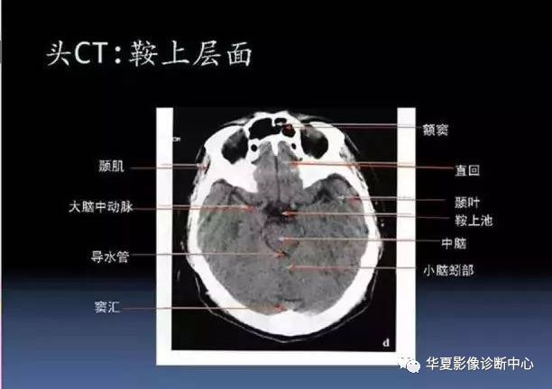 四叠体池解剖图片