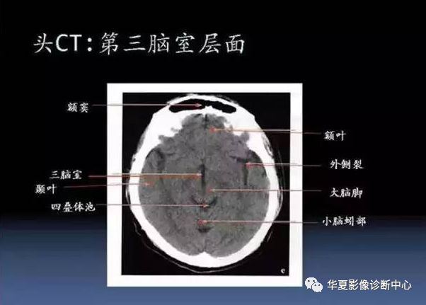 00mm )九面:聽眥蝶鞍三下上 體頂卵園灰質象腳大:腳間池,大腦大靜脈池