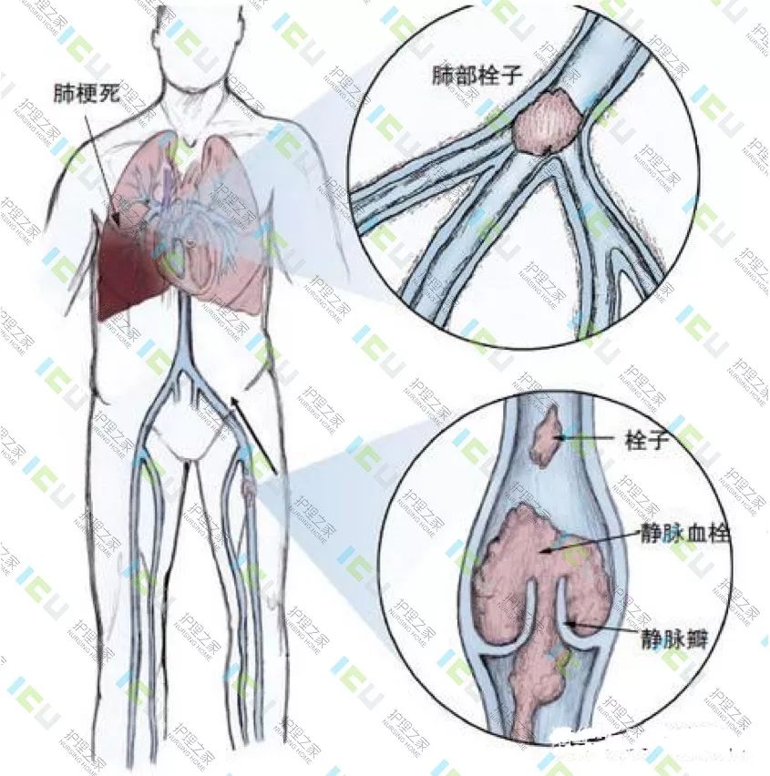 下肢深静脉血栓解剖图图片