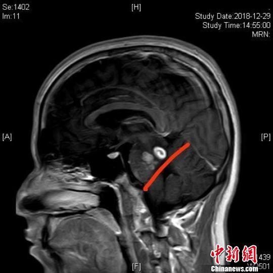 圖為患者頭部核磁共振影像,紅色標記線上方的白色區域為寄生蟲.