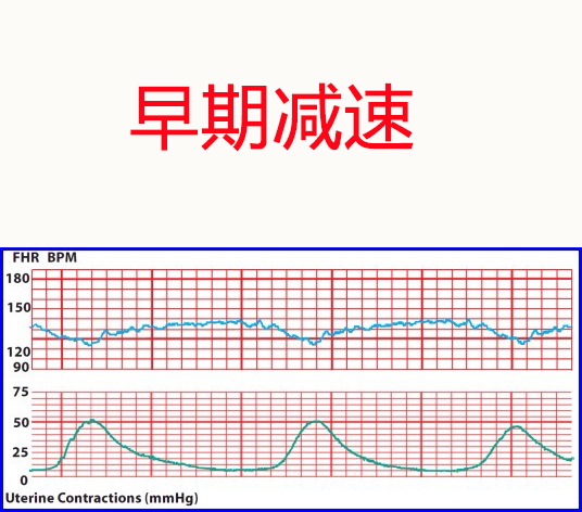 胎心监护曲线图解读图片