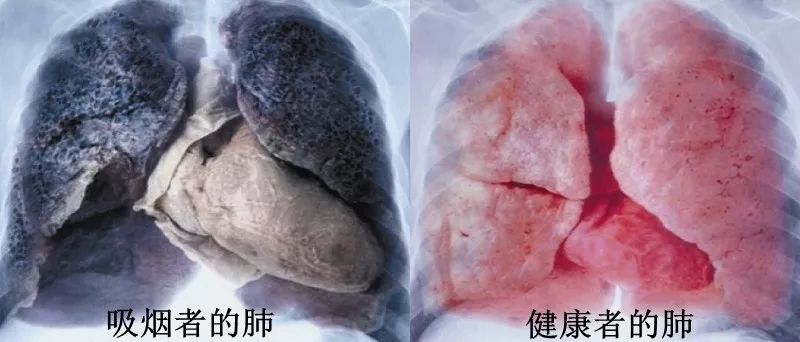 吸烟肺的变化过程图片