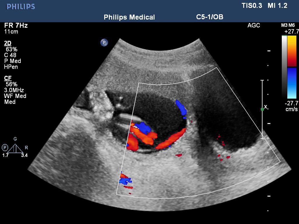 帆状胎盘超声图图片
