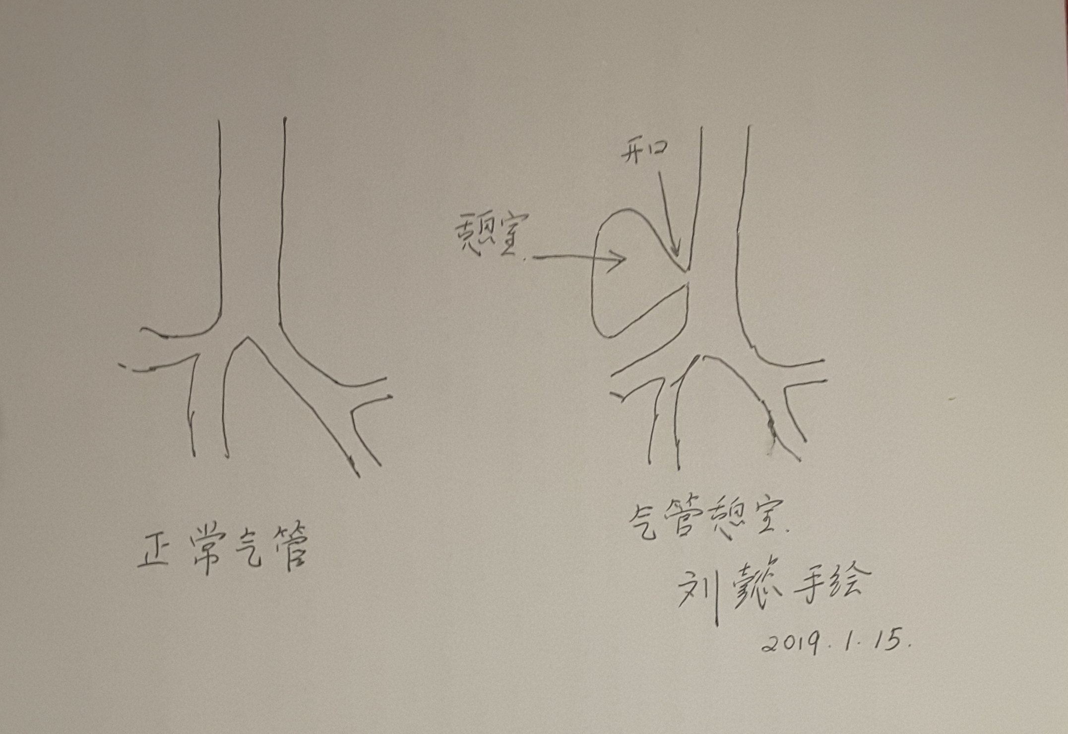 回盲部憩室图片图片