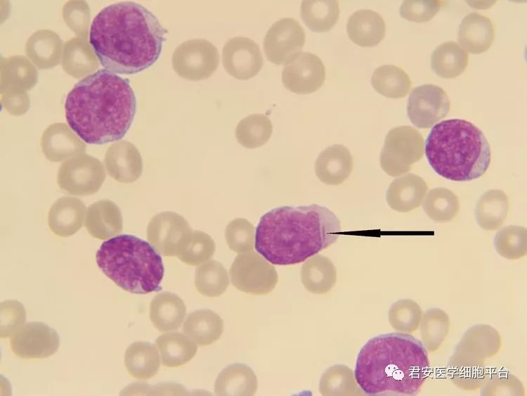 ▼「auer小体」形态描述:细胞胞质内一根细小的紫红色棒状结构,由胞质